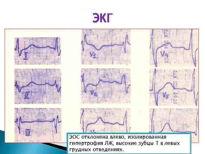 ЭКГ ЭОС отклонена влево, изолированная гипертрофия ЛЖ, высокие зубцы Т в левых грудных отведениях.