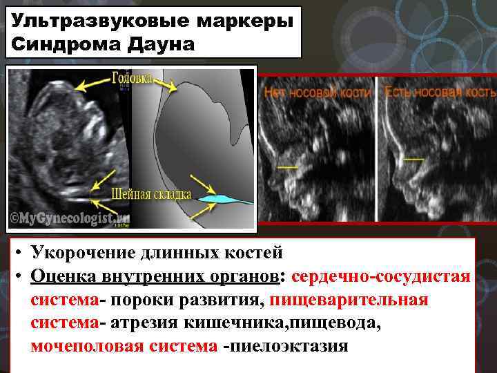 Ультразвуковые маркеры Синдрома Дауна • Укорочение длинных костей • Оценка внутренних органов: сердечно-сосудистая система-