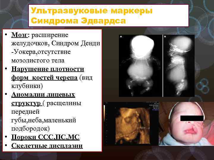 Ультразвуковые маркеры Синдрома Эдвардса • Мозг: расширение желудочков, Синдром Денди -Уокера, отсутствие мозолистого тела