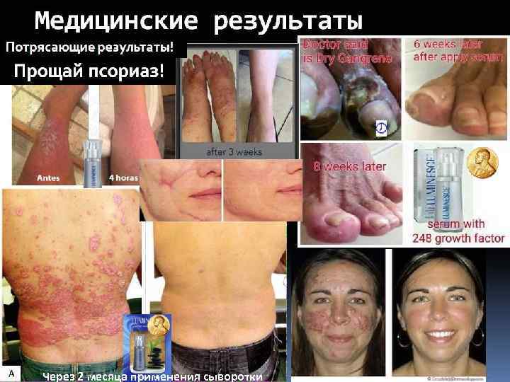 Через 2 месяца применения сыворотки 