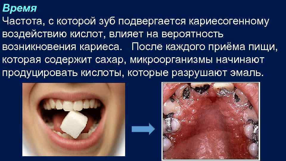 Время Частота, с которой зуб подвергается кариесогенному воздействию кислот, влияет на вероятность возникновения кариеса.