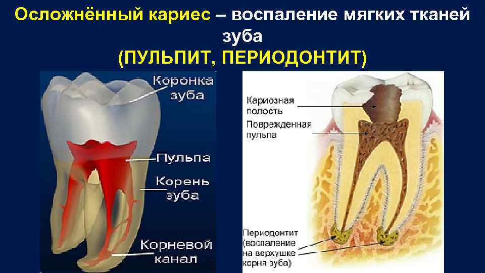 Осложнённый кариес – воспаление мягких тканей зуба (ПУЛЬПИТ, ПЕРИОДОНТИТ) 