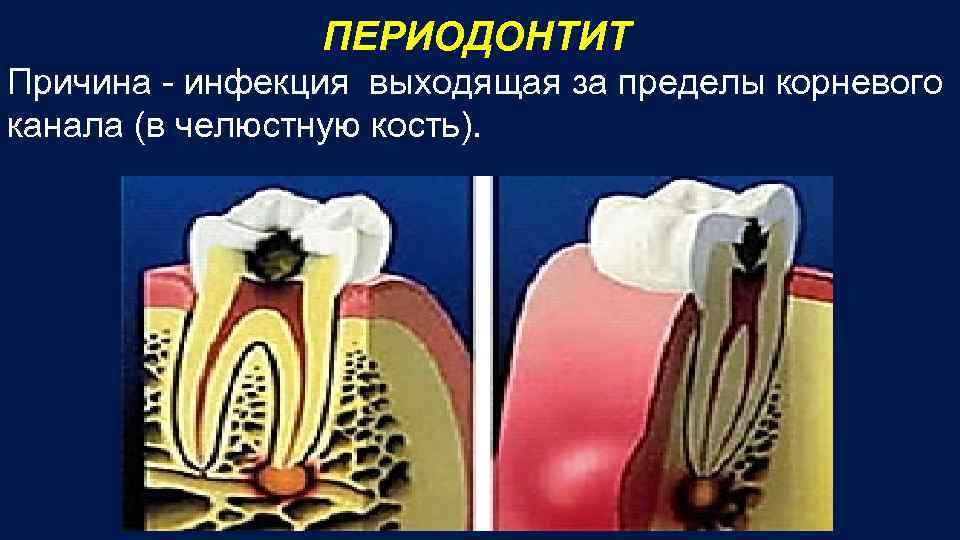 ПЕРИОДОНТИТ Причина - инфекция выходящая за пределы корневого канала (в челюстную кость). 