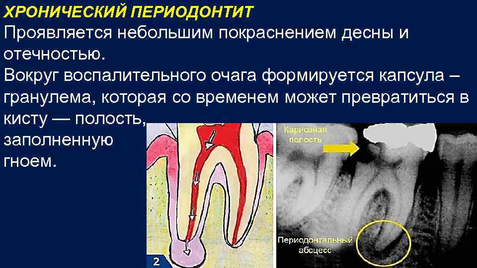 ХРОНИЧЕСКИЙ ПЕРИОДОНТИТ Проявляется небольшим покраснением десны и отечностью. Вокруг воспалительного очага формируется капсула –