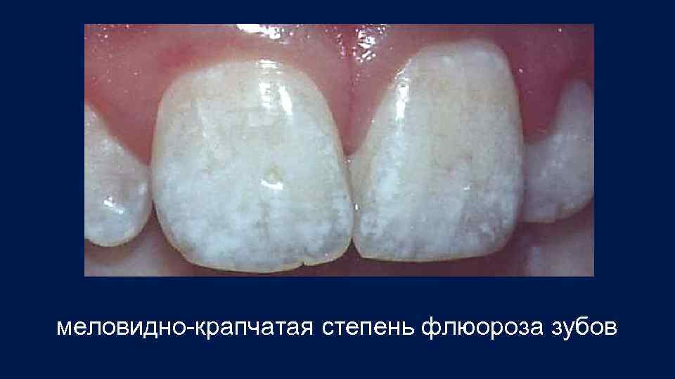 меловидно-крапчатая степень флюороза зубов 