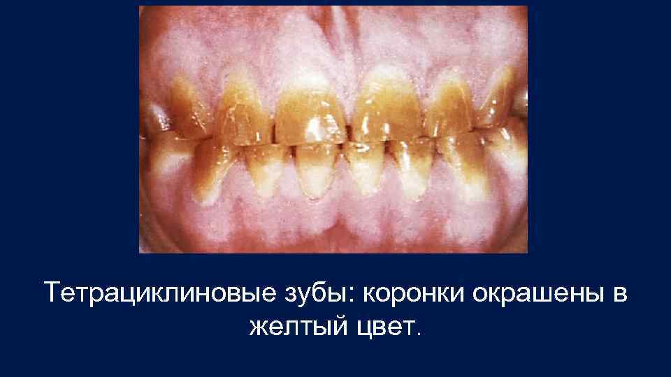 Тетрациклиновые зубы: коронки окрашены в желтый цвет. 