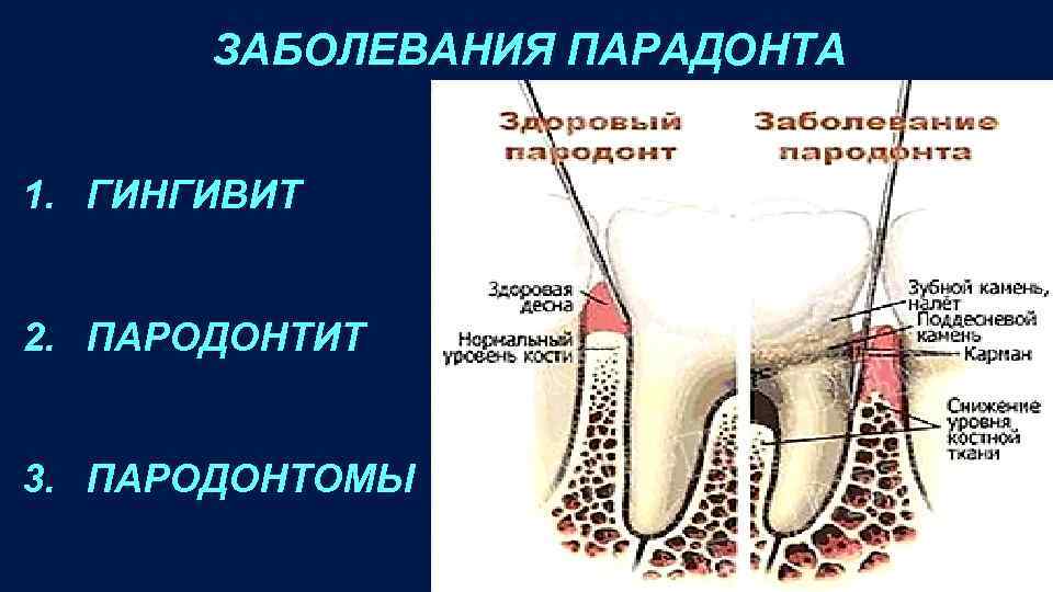 ЗАБОЛЕВАНИЯ ПАРАДОНТА 1. ГИНГИВИТ 2. ПАРОДОНТИТ 3. ПАРОДОНТОМЫ 