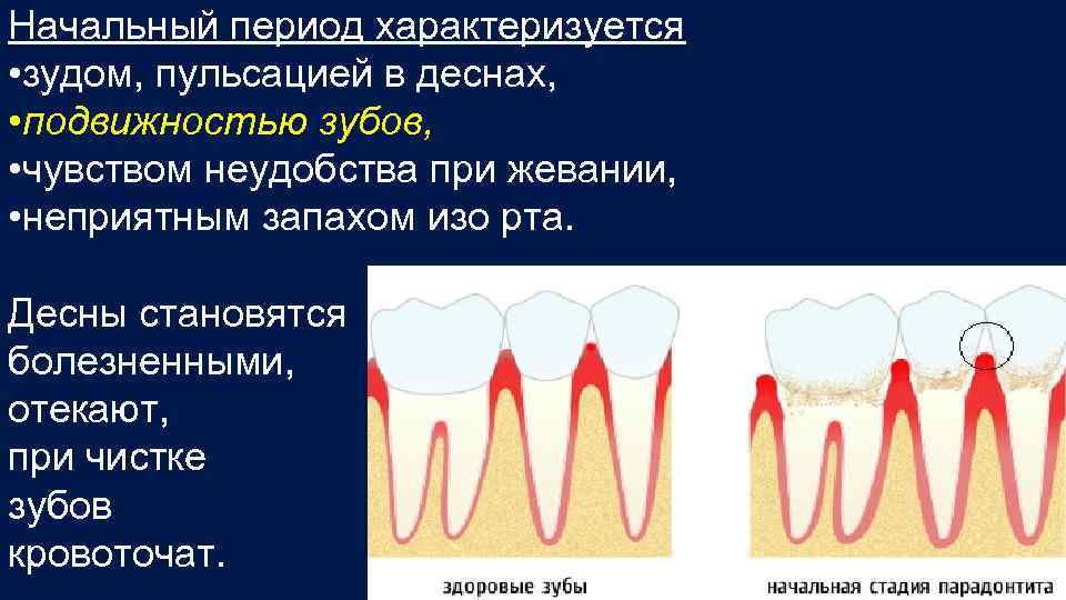 Начальный период характеризуется • зудом, пульсацией в деснах, • подвижностью зубов, • чувством неудобства