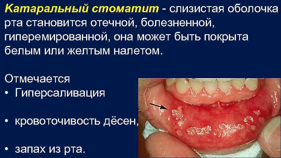Kатаральный стоматит - слизистая оболочка рта становится отечной, болезненной, гиперемированной, она может быть покрыта
