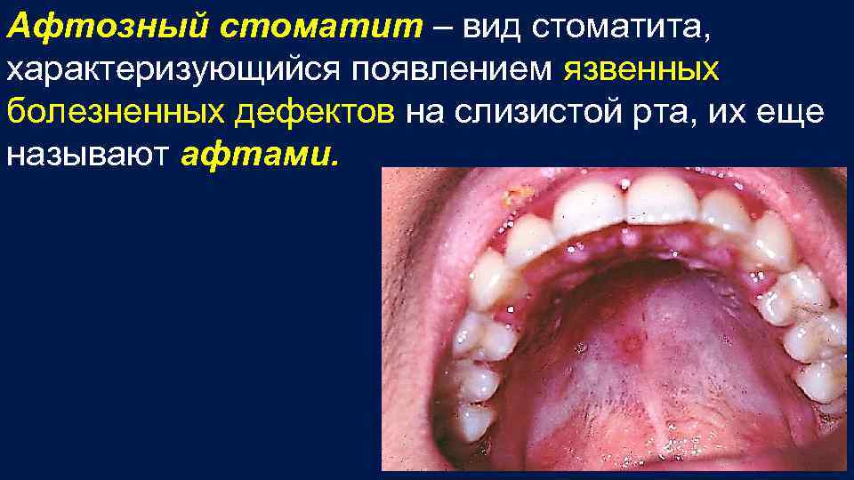 Афтозный стоматит – вид стоматита, характеризующийся появлением язвенных болезненных дефектов на слизистой рта, их