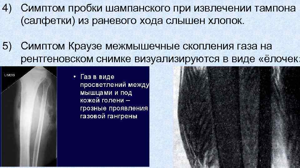 4) Симптом пробки шампанского при извлечении тампона (салфетки) из раневого хода слышен хлопок. 5)