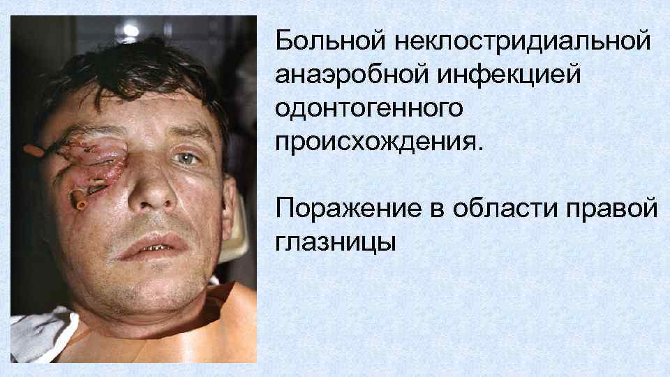 Больной неклостридиальной анаэробной инфекцией одонтогенного происхождения. Поражение в области правой глазницы 