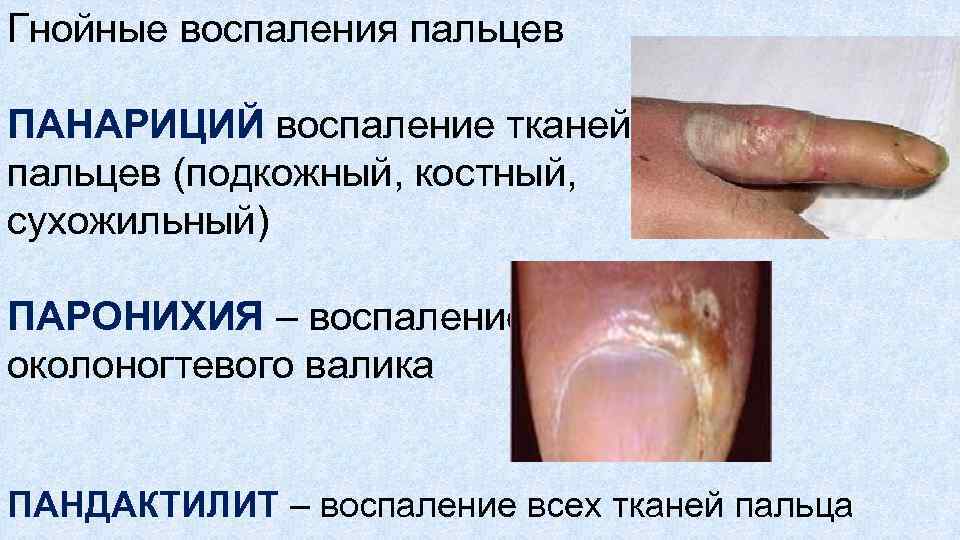 Гнойные воспаления пальцев ПАНАРИЦИЙ воспаление тканей пальцев (подкожный, костный, сухожильный) ПАРОНИХИЯ – воспаление околоногтевого