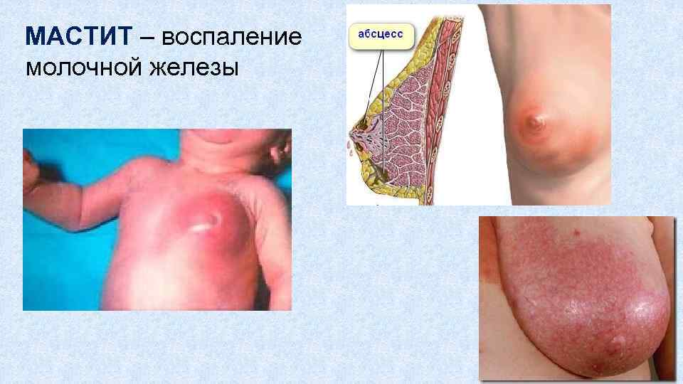 МАСТИТ – воспаление молочной железы 