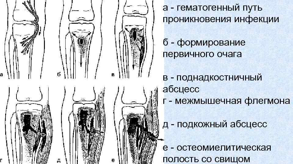 а гематогенный путь проникновения инфекции б формирование первичного очага в поднадкостничный абсцесс г межмышечная