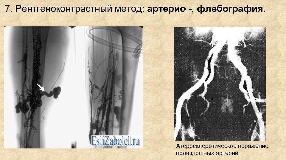 7. Рентгеноконтрастный метод: артерио -, флебография. Атеросклеротическое поражение подвздошных артерий 