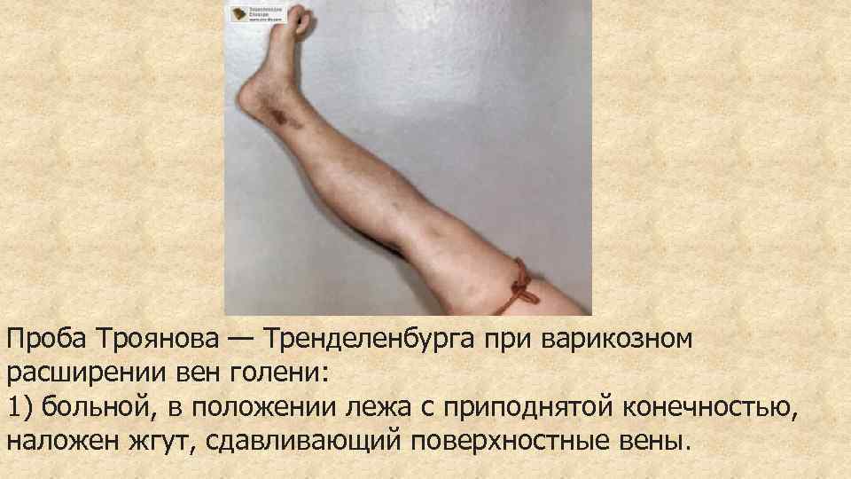 Проба Троянова — Тренделенбурга при варикозном расширении вен голени: 1) больной, в положении лежа
