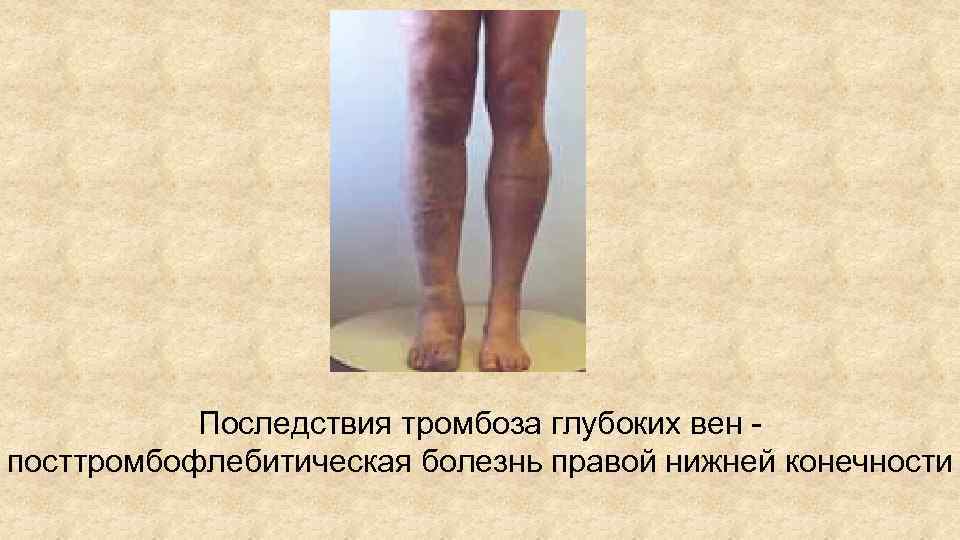 Последствия тромбоза глубоких вен - посттромбофлебитическая болезнь правой нижней конечности 