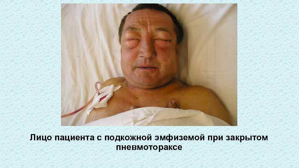 Лицо пациента с подкожной эмфиземой при закрытом пневмотораксе 