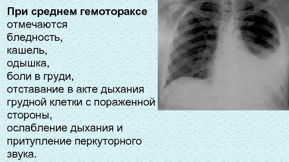 При среднем гемотораксе отмечаются бледность, кашель, одышка, боли в груди, отставание в акте дыхания
