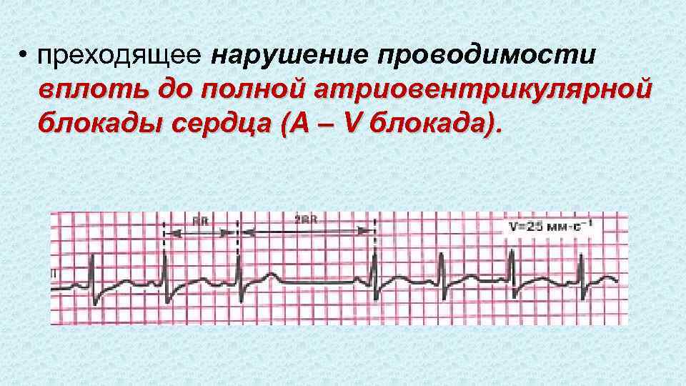  • преходящее нарушение проводимости вплоть до полной атриовентрикулярной блокады сердца (A – V