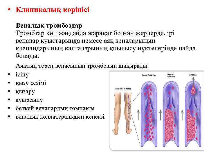  • Клиникалық көрінісі Веналық тромбоздар Тромбтар көп жағдайда жарақат болған жерлерде, ірі веналар