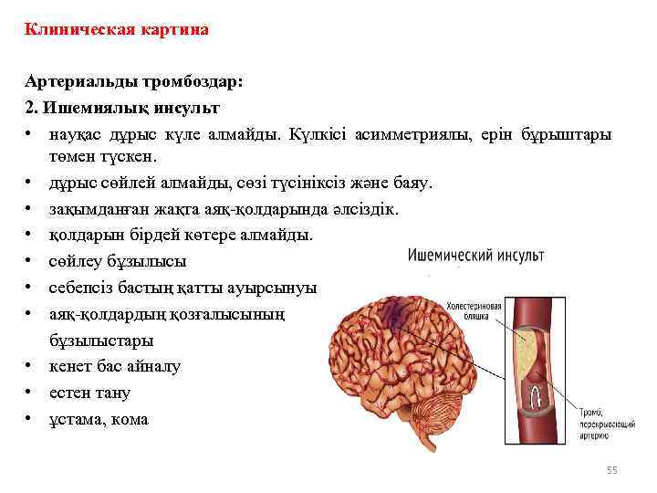 Клиническая картина Артериальды тромбоздар: 2. Ишемиялық инсульт • науқас дұрыс күле алмайды. Күлкісі асимметриялы,