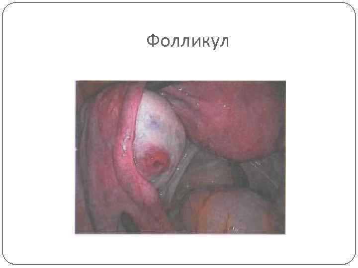 Фолликул 