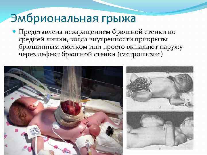 Эмбриональная грыжа Представлена незаращением брюшной стенки по средней линии, когда внутренности прикрыты брюшинным листком
