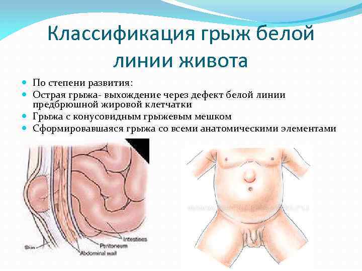 Классификация грыж белой линии живота По степени развития: Острая грыжа выхождение через дефект белой