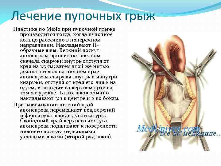 Лечение пупочных грыж Пластика по Мейо при пупочной грыже производится тогда, когда пупочное кольцо