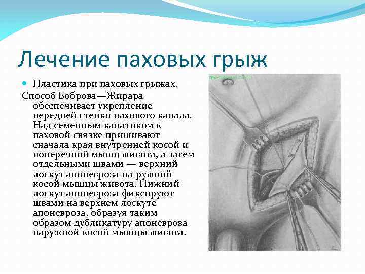 Схемы пластики пахового канала при прямых и косых паховых грыжах