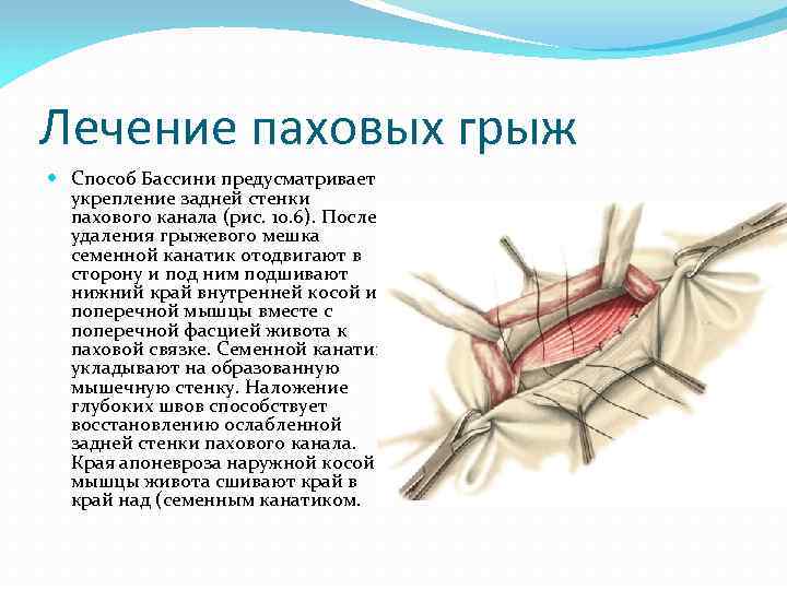 Схема топографии пахового канала