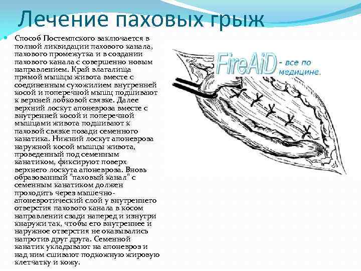Лечение паховых грыж Способ Постемпского заключается в полной ликвидации пахового канала, пахового промежутка и