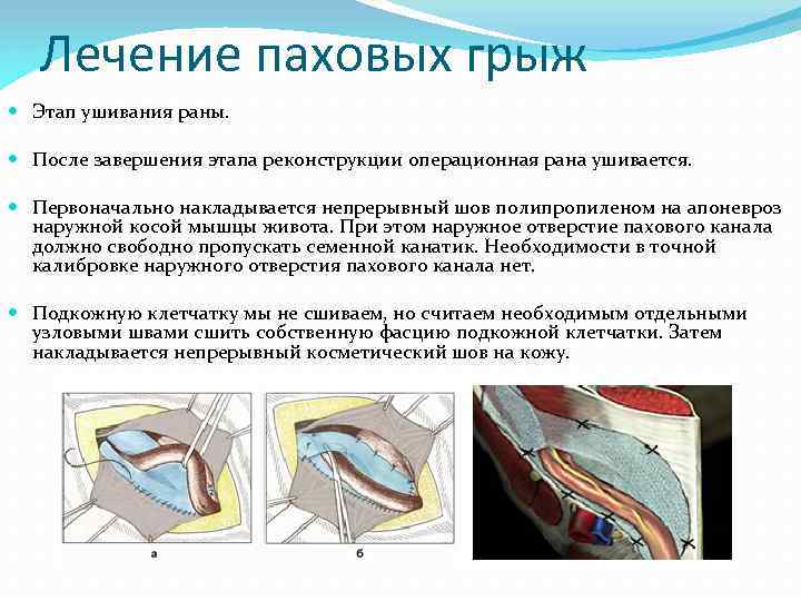 Лечение паховых грыж Этап ушивания раны. После завершения этапа реконструкции операционная рана ушивается. Первоначально
