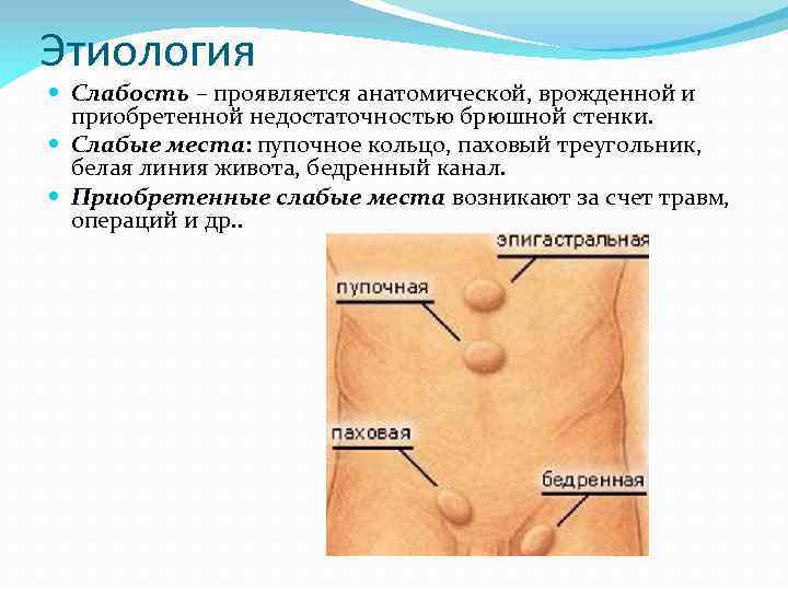 Этиология Слабость – проявляется анатомической, врожденной и приобретенной недостаточностью брюшной стенки. Слабые места: пупочное