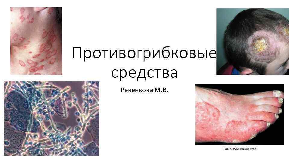 Противогрибковые средства Ревенкова М. В. 