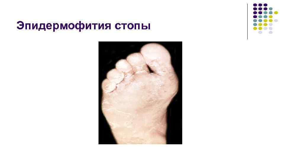 Эпидермофития стопы 