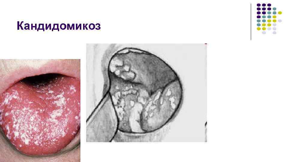 Кандидомикоз 