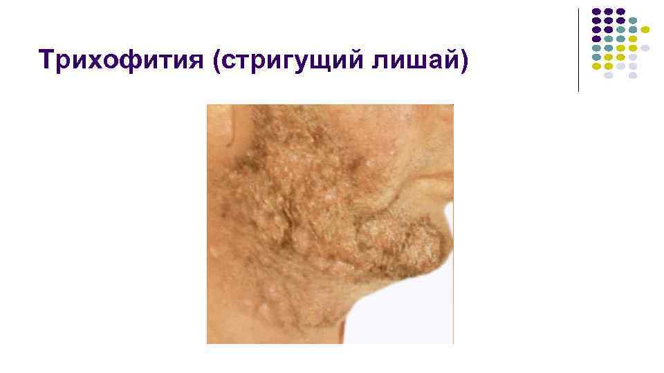 Трихофития (стригущий лишай) 