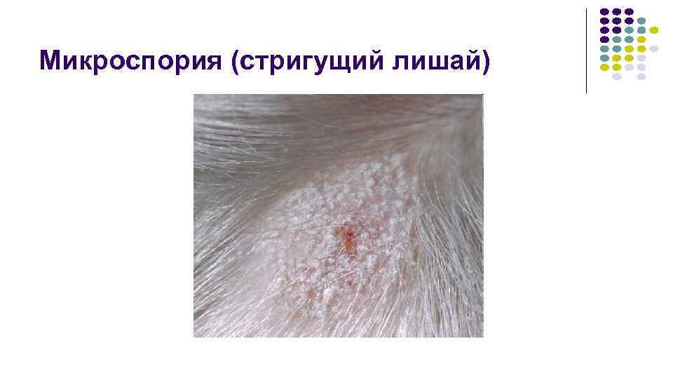 Микроспория (стригущий лишай) 