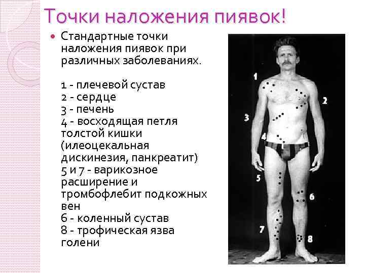 Точки наложения пиявок! Стандартные точки наложения пиявок при различных заболеваниях. 1 - плечевой сустав