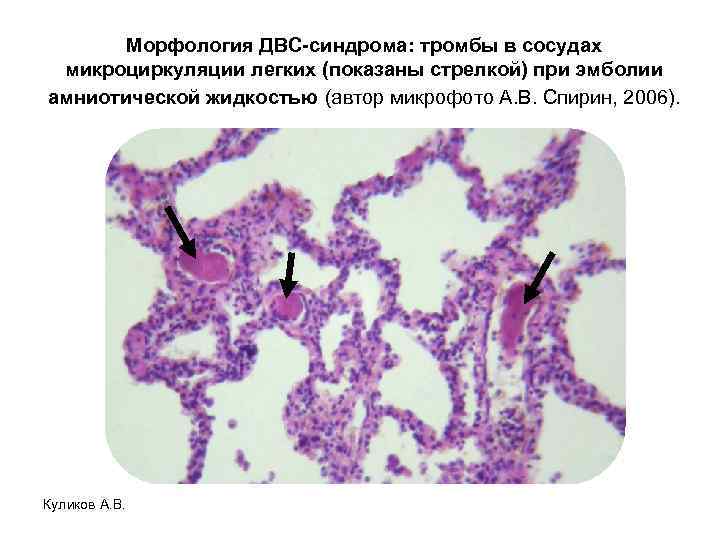 Морфология ДВС-синдрома: тромбы в сосудах микроциркуляции легких (показаны стрелкой) при эмболии амниотической жидкостью (автор