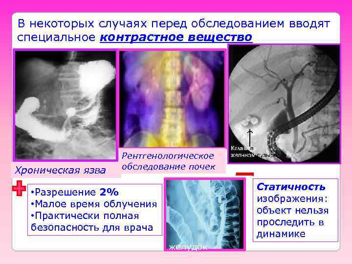 В некоторых случаях перед обследованием вводят специальное контрастное вещество Хроническая язва Рентгенологическое обследование почек