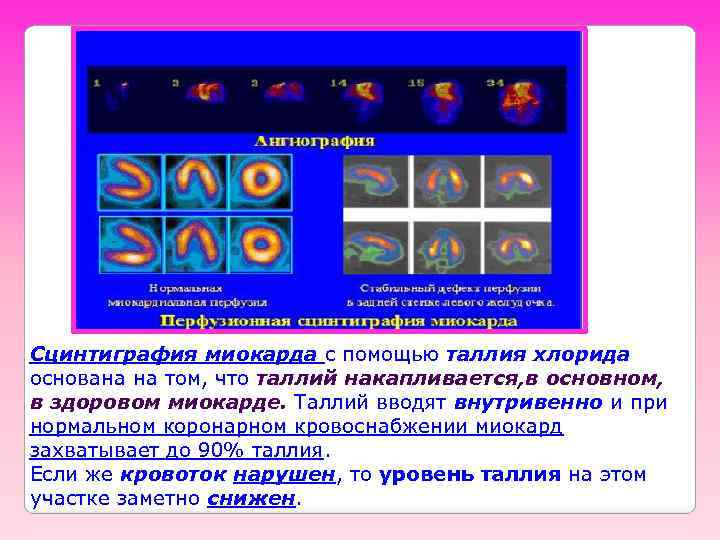 Сцинтиграфия миокарда с помощью таллия хлорида основана на том, что таллий накапливается, в основном,