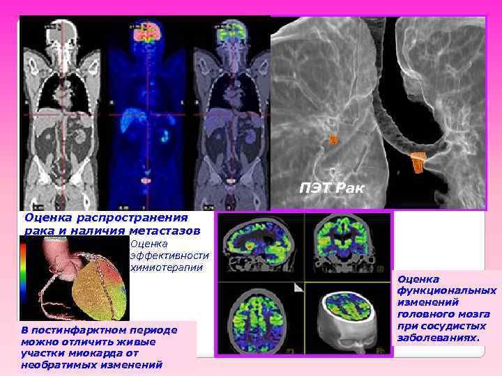 ПЭТ Рак Оценка распространения рака и наличия метастазов Оценка эффективности химиотерапии В постинфарктном периоде