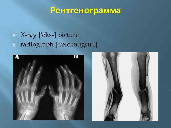 Рентгенограмма X-ray ['eks-] picture radiograph ['reɪdɪəugrɑ: f] 