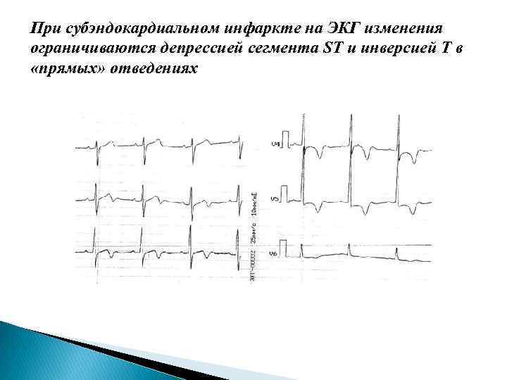 Субэндокардиальная ишемия боковой стенки