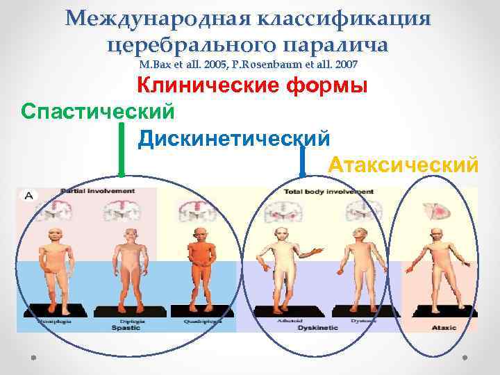 Международная классификация церебрального паралича M. Bax et all. 2005, P. Rosenbaum et all. 2007