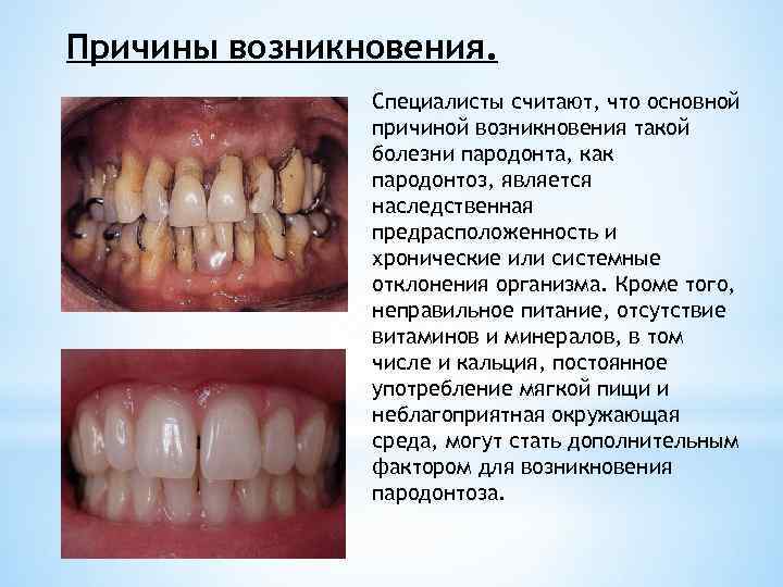 Причины возникновения. Специалисты считают, что основной причиной возникновения такой болезни пародонта, как пародонтоз, является